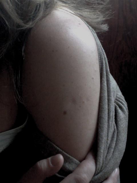 Cicatrice vaccin